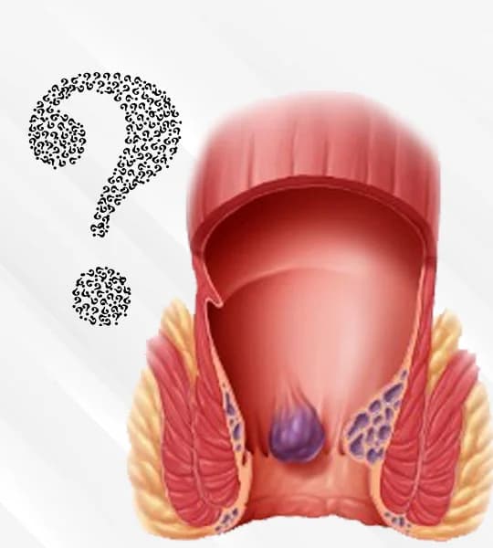 Anal Fissure Botox