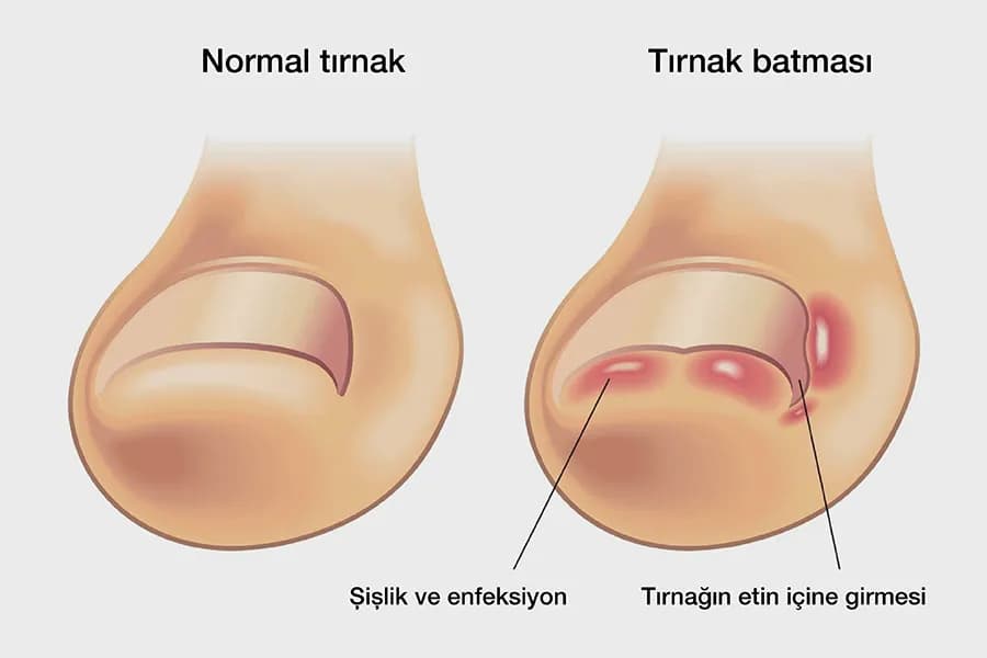 Ingrown Toenail