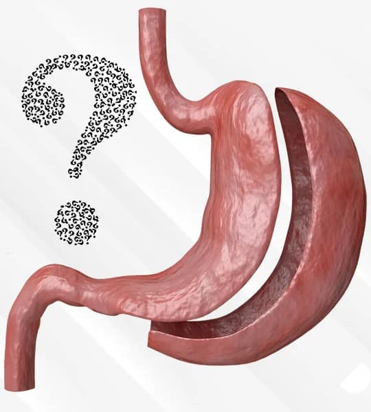 Sleeve Gastrectomy